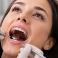 Understanding Lingual Braces: The Hidden Orthodontic Solution